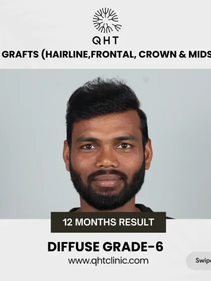 The end of Diffuse Grade 6 baldness. With a 5000-graft hair transplant, we achieved full coverage for the frontal hairline, mid-scalp, and crown.