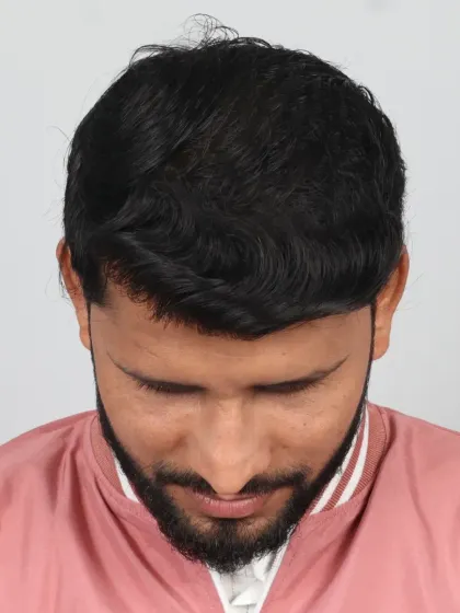 A 9-month transformation for a Diffuse Grade 5A patient. We used 4800 grafts to achieve dense, even coverage and a natural hairline.