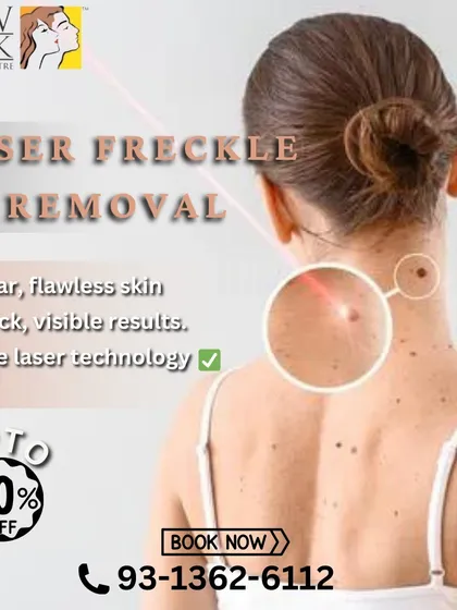 We offer safe and effective laser freckle removal for clients seeking clear, flawless skin. Our technology precisely targets the melanin in each freckle to lighten and remove them, often with quick and visible results.