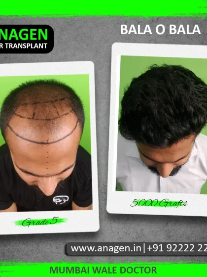"Bala O Bala!" This patient's Grade 5 baldness was transformed with 5000 grafts, resulting in a full and impressive head of hair. A truly life changing result.