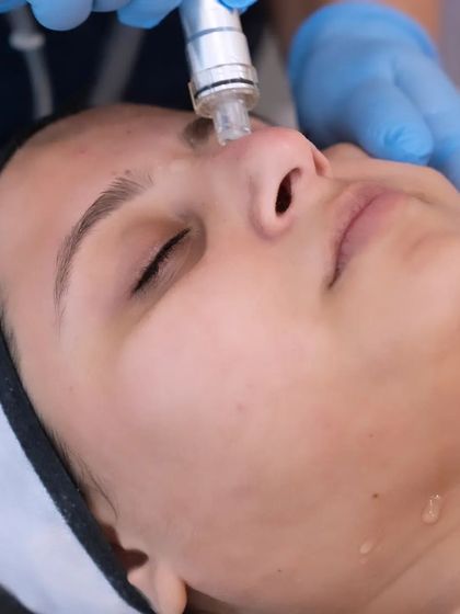 The HydraPro wand glides over the skin, providing a non-invasive yet highly effective treatment. You can see the drops of hydrating serum being delivered to the skin.