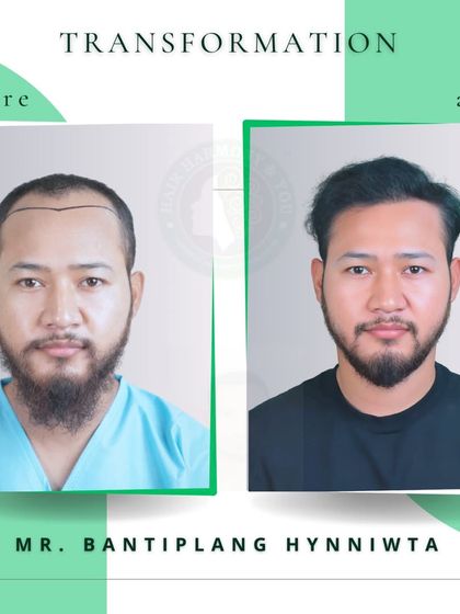 From a receding hairline to a full, stylish look, Mr. Bantiplang Hynniwta's before and after photos showcase a complete transformation. The result is both natural and confidence-boosting.