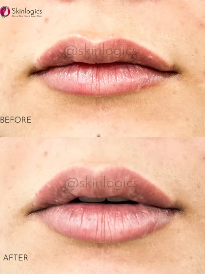Here is another example of my lip filler work. You can see the subtle increase in volume and improved symmetry, resulting in lips that look naturally plump and well-defined.
