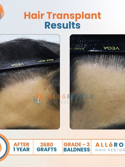 A one-year result for a Grade 3 baldness case using 2680 grafts. These images show the transformation from multiple angles, highlighting the restored density and the clean, natural hairline I designed.