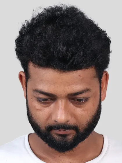 This 13-month result for a Grade 6 baldness case shows what's possible with 6300 grafts. We restored his hair, style, and youthful appearance.