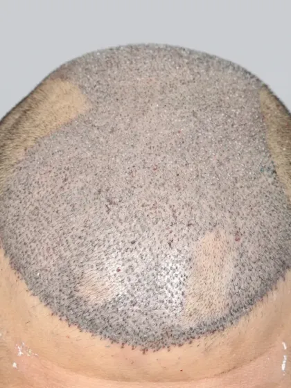 The result of implanting 5900 grafts for a Diffuse Grade 6 patient, showing the density and coverage achieved.