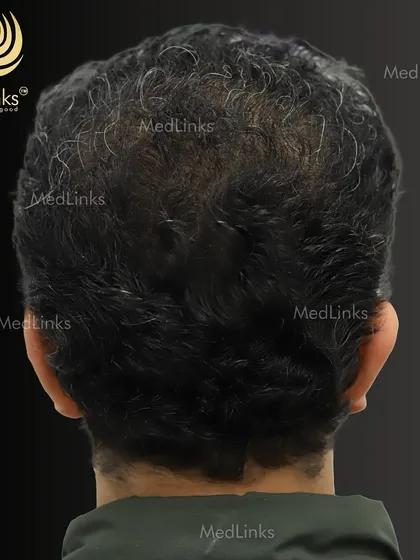 The after shot of the crown area, now with full and dense coverage.