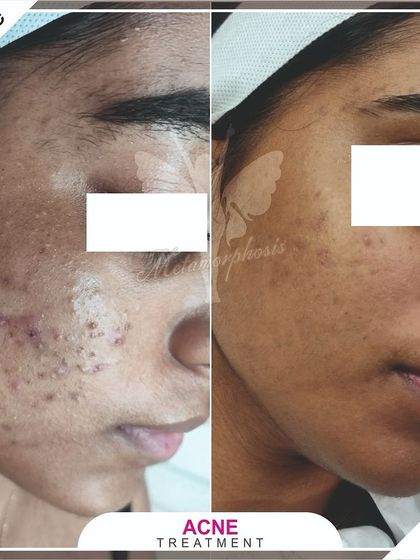 With a personalized plan of chemical peels and home care, we achieved this significant reduction in active acne and inflammation.