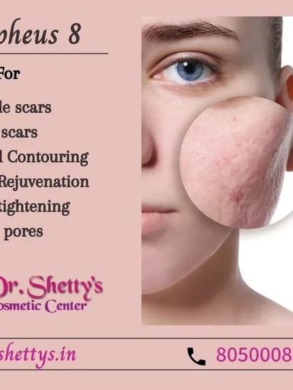 Morpheus8 is one of my most effective treatments for skin texture issues. It helps with reducing the appearance of acne scars, pimple marks, and open pores, while also providing skin tightening and facial contouring for overall skin rejuvenation.
