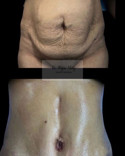 Body Contouring Surgery