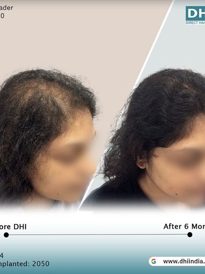 Another side-profile view of the same client's 6-month progress. The restored hairline and increased thickness are clearly visible, showcasing a natural and beautiful result.