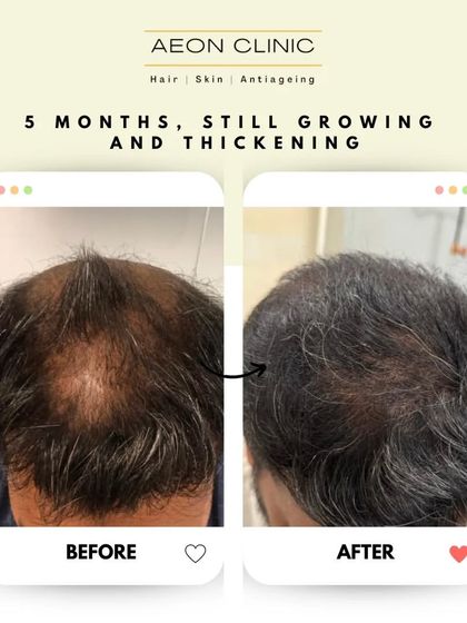 Just 5 months post-procedure, and the hair is still growing and thickening. This image shows the promising progress on the journey to full results.