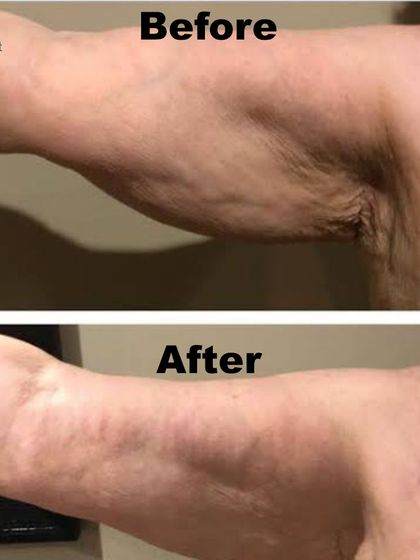 A dramatic before and after of an arm skin tightening treatment. This shows how we can address skin laxity on different parts of the body for a firmer appearance.