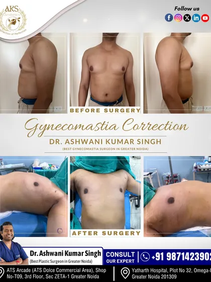 This patient's transformation through Gynecomastia surgery shows a significant change in chest contour. I carefully removed excess glandular tissue and fat to create a flatter, more masculine chest. Notice the improved definition from both the front and side profiles.