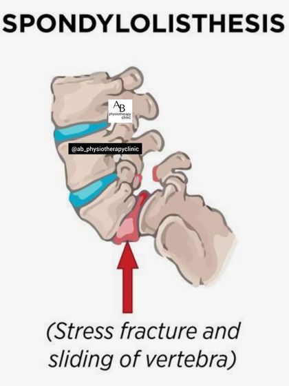 Spondylolisthesis occurs when a vertebra slides forward over the one below it, often due to a fracture. This slippage can compress nerves, causing significant pain that I manage with stabilization exercises and manual therapy.