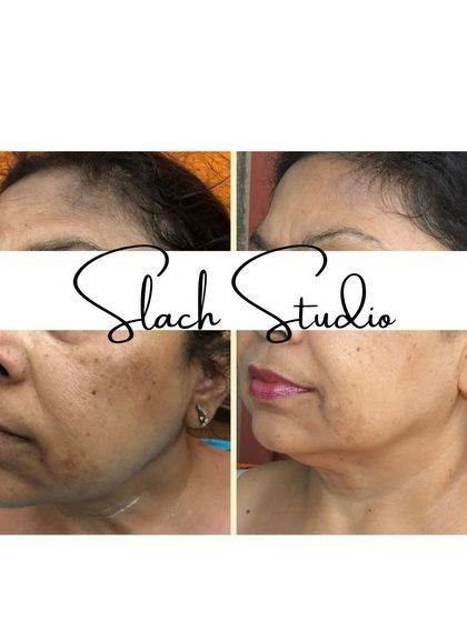This collage shows a visible lifting and brightening effect, along with a reduction in pigmentation and improved skin texture.
