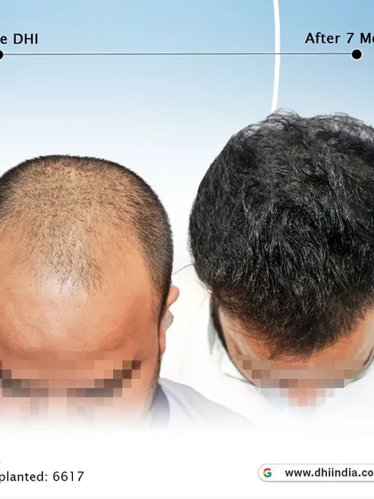 A top-down view of a 30-year-old client 7 months after his procedure. With 6,617 hairs implanted, the transformation in density and coverage is already outstanding.