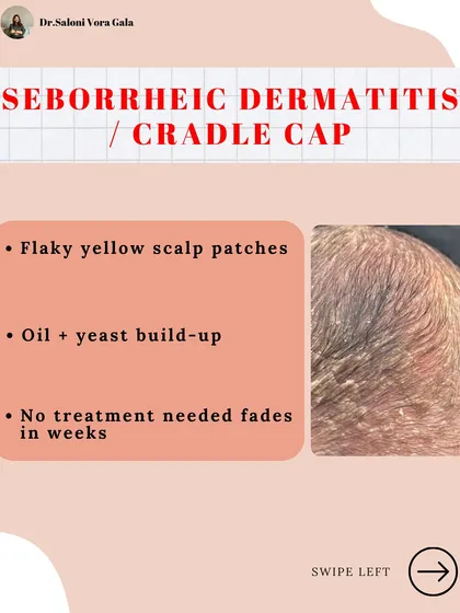 For new parents, not all baby rashes are a cause for panic. This is Seborrheic Dermatitis, also known as cradle cap. It appears as flaky yellow patches from oil and yeast build-up and typically fades on its own in a few weeks without any treatment.