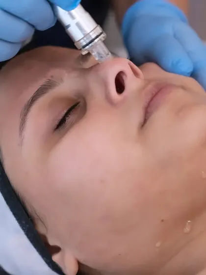Here you can see the HydraPro tool in action. This is a key part of my deep hydration facial, using advanced technology to gently exfoliate and infuse the skin with moisture for that instant, dewy glow.