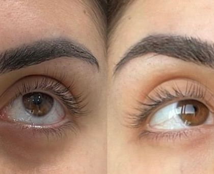 A great example of the brightening and smoothing effect of the treatment, making the entire eye area appear more youthful and awake.