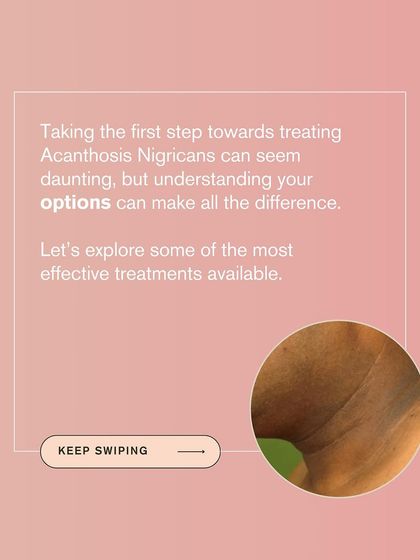 Understanding your options is the first step to treating Acanthosis Nigricans, a condition causing dark patches. This graphic introduces some of the most effective treatments available.