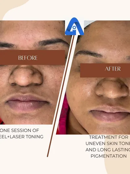 This before and after shows the result of one session combining a chemical peel with laser toning. This dual approach is effective for tackling long-standing pigmentation and achieving a more even skin tone.