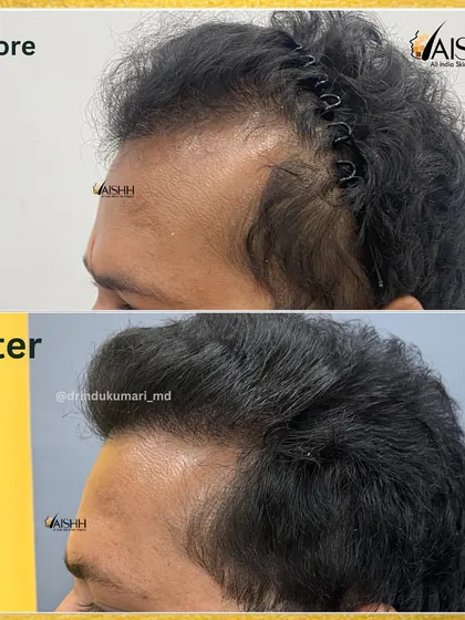 Another side view, showing the patient's hair before the transplant with a hairband pulling it back, contrasted with the full, dense result after 7 months.