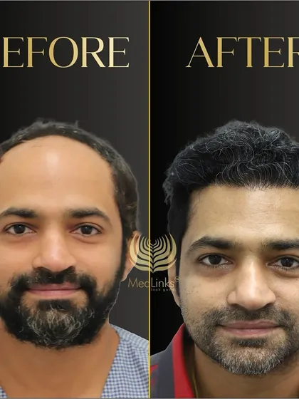 A fantastic before and after result for this patient, who now has a full and natural-looking head of hair.
