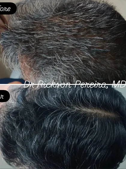 This transformation after eight months is a testament to patience and a consistent, science-based approach. There are no miracle cures for hair loss; exceptional outcomes are achieved when we work together as a team, following a structured medical plan.
