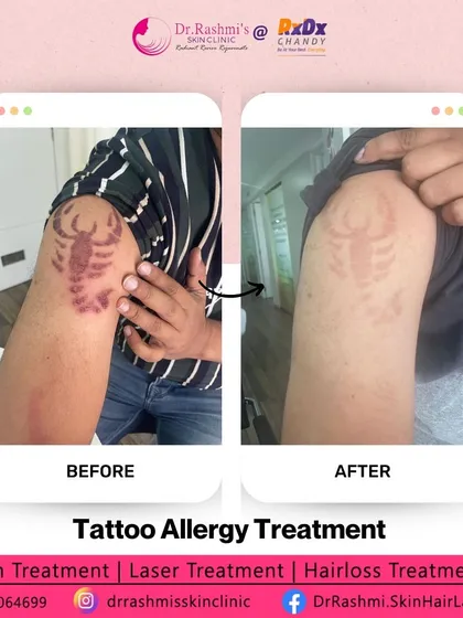 This image shows the successful resolution of a tattoo ink allergy. While my focus is often on acne, this case demonstrates my approach to complex dermatological issues: accurate diagnosis followed by a targeted treatment plan to restore the skin's health and appearance.