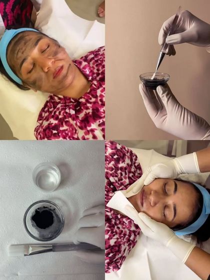 A four-part image showing the key stages of a Carbon Laser Peel. It includes the preparation of the carbon paste, its application, and the client's relaxed state during the rejuvenating treatment.