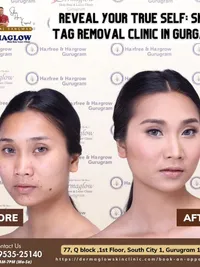 Mole, Wart & Skin Tag Removal