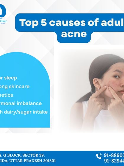 An informational graphic detailing the top five causes of adult acne. Understanding triggers like hormonal imbalance, genetics, and diet is the first step toward an effective, long term acne management plan.