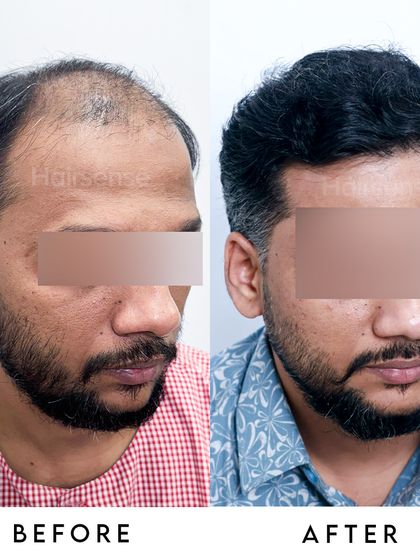 This angled view demonstrates the complete coverage of the frontal and mid-scalp regions, eliminating the appearance of thinning.