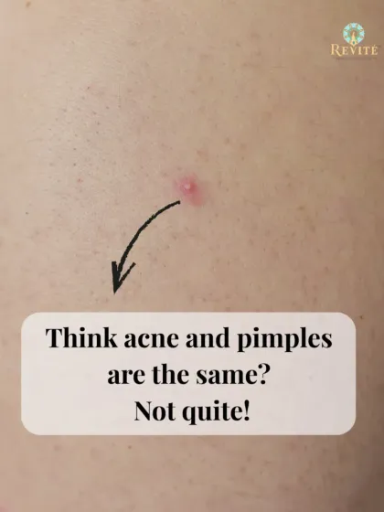 Think acne and pimples are the same? Not quite. Understanding the difference is the first step to treating them effectively, which is why I created my Anti-Acne Face Wash for deeper, recurring issues.