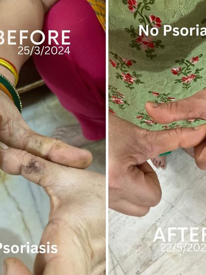 This before and after photo shows the healing of my mom's Psoriasis on her finger. This transformation was achieved not with pills, but with changes to her diet and lifestyle based on yogic principles. It shows that the body can heal itself with the right support.