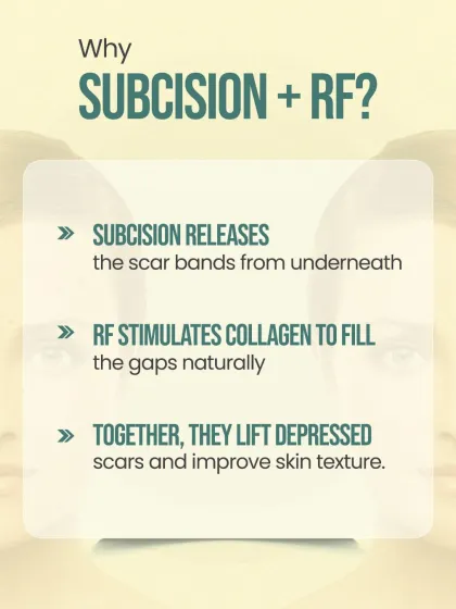 Combining Subcision with RF is highly effective for depressed acne scars. Subcision releases the scar from underneath, while the radiofrequency energy stimulates your body's natural collagen production to fill the resulting gap and smooth the skin's surface.