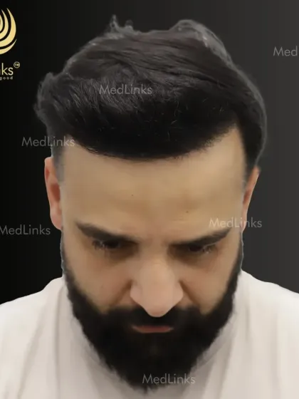 The after shot from above showcases the excellent density and coverage achieved. The hair can be combed and styled naturally, a key indicator of a successful transplant.