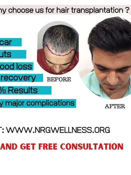Why choose us for your hair transplantation? We guarantee a procedure with no scars or cuts, fast recovery, and 100% results, all with no major complications. Visit us for a free consultation to learn more.