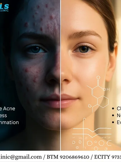 This transformation shows the journey from active, inflamed acne to clear, calm skin. My approach goes beyond surface treatments to address the root causes of breakouts, using a combination of clinical procedures and personalized skincare to restore skin health and confidence.