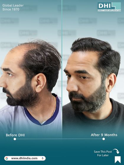 Another side-profile view of the 9-month result. The hairline is expertly crafted to blend seamlessly with the client's features, highlighting the artistic precision of our surgeons.