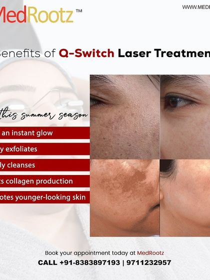 The Q-Switch laser is particularly beneficial for achieving an instant glow and promoting younger-looking skin. It gently exfoliates, deeply cleanses, and boosts collagen production, which is ideal for skin maintenance.