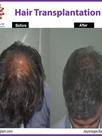 Hair Restoration