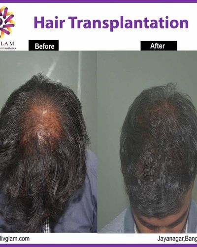 Hair Restoration
