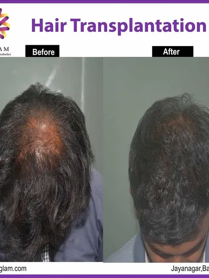 This before and after comparison demonstrates the effectiveness of our hair transplant treatment for significant thinning on the crown. The result is thicker, healthier-looking hair.