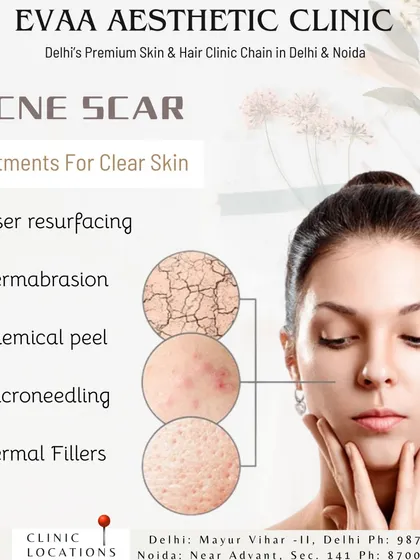 We offer several effective treatments for acne scars to achieve clear skin. Our options include laser resurfacing, chemical peels, microneedling, and dermal fillers, tailored to your skin's needs.