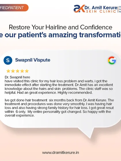 My greatest satisfaction comes from seeing my patients regain their confidence. This review from Swapnil highlights his experience with my hair loss treatment, noting the smooth procedure and the personality-changing results he saw within six months.