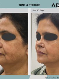 Pigmentation & Skin Brightening