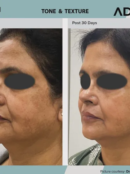 This is the result of a personalized AdvaTx laser plan to correct years of sun damage and uneven skin tone. Notice the significant reduction in pigmentation and the overall improvement in skin texture and brightness after just 30 days.