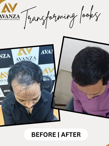 No filters, just real results. This client's hair was restored with a focus on natural density and a soft hairline, creating a look that is both full and believable.